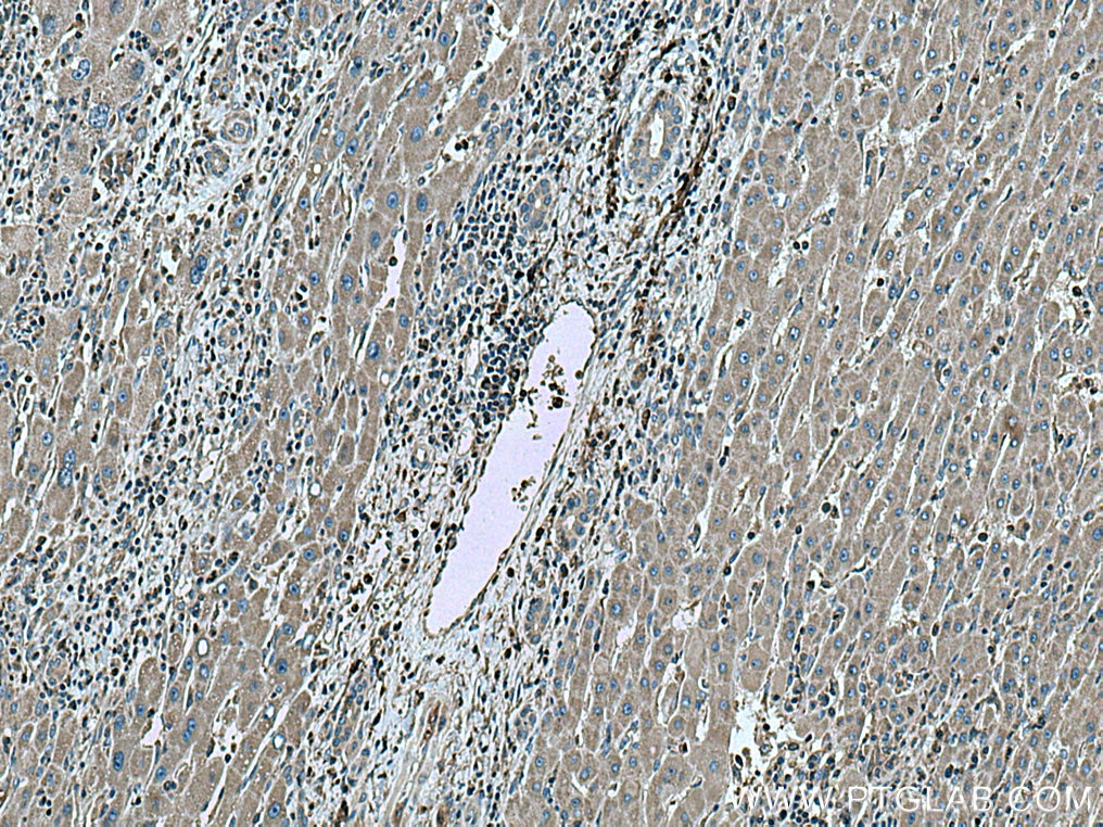 IHC staining of human liver cancer using 25413-1-AP