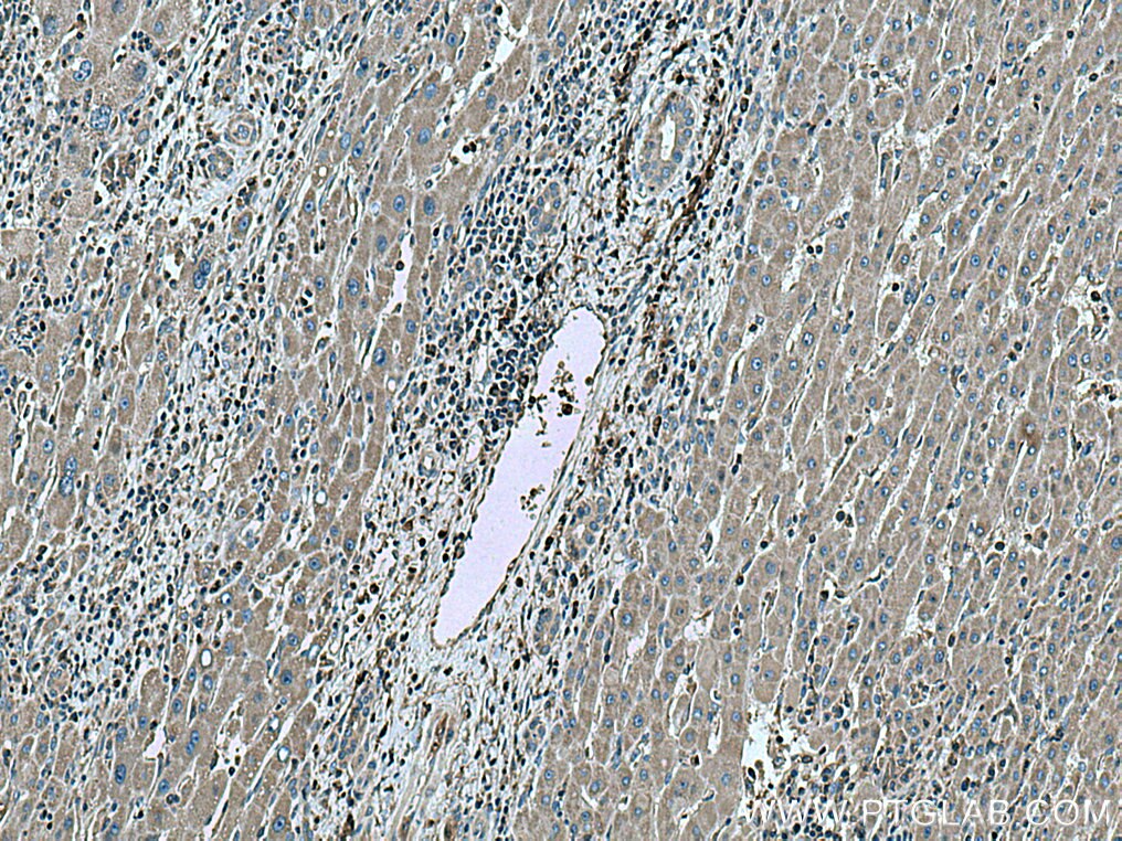 Immunohistochemistry (IHC) staining of human liver cancer tissue using G6PD Polyclonal antibody (25413-1-AP)