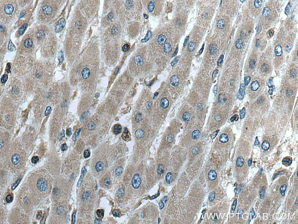 Immunohistochemistry (IHC) staining of human liver cancer tissue using G6PD Polyclonal antibody (25413-1-AP)