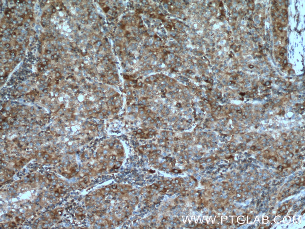 Immunohistochemistry (IHC) staining of human liver cancer tissue using G6PD Monoclonal antibody (66373-1-Ig)