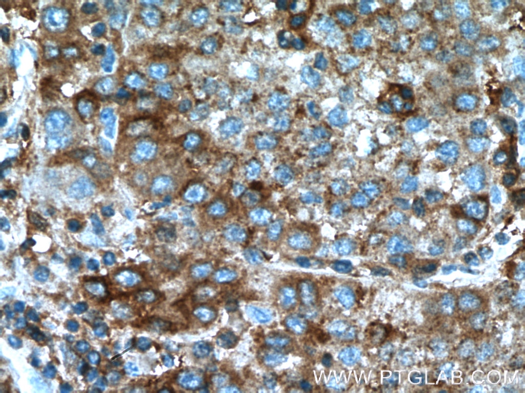Immunohistochemistry (IHC) staining of human liver cancer tissue using G6PD Monoclonal antibody (66373-1-Ig)