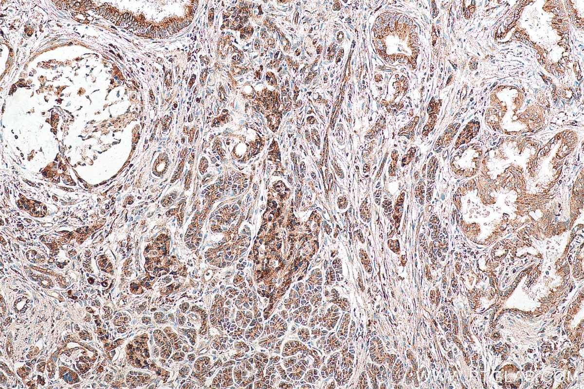 Immunohistochemistry (IHC) staining of human pancreas cancer tissue using GAA Polyclonal antibody (14367-1-AP)