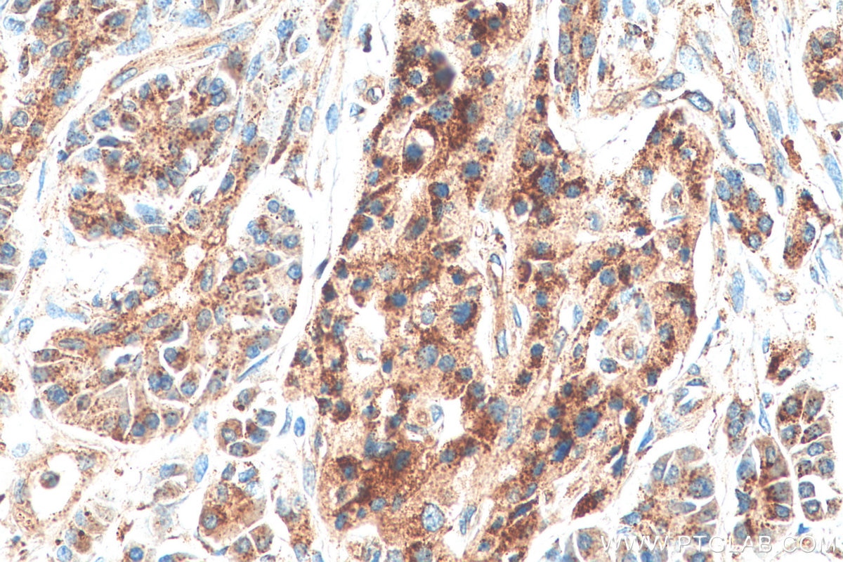 Immunohistochemistry (IHC) staining of human pancreas cancer tissue using GAA Polyclonal antibody (14367-1-AP)