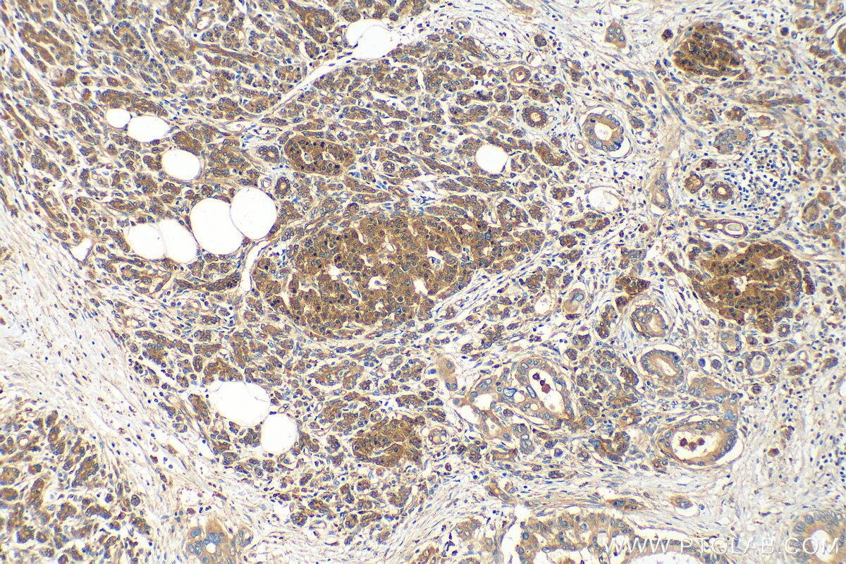 Immunohistochemistry (IHC) staining of human pancreas cancer tissue using GAA Polyclonal antibody (14367-1-AP)