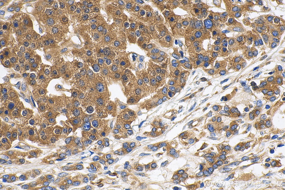 Immunohistochemistry (IHC) staining of human pancreas cancer tissue using GAA Polyclonal antibody (14367-1-AP)