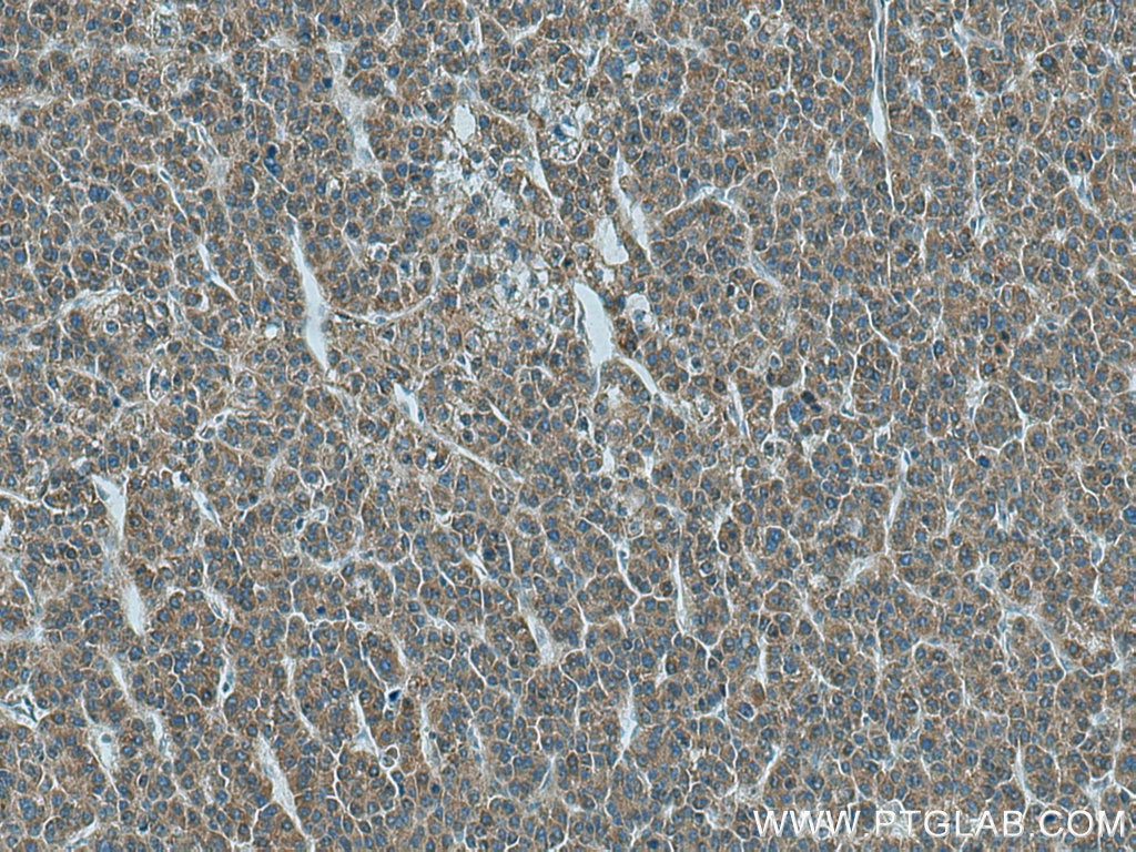 Immunohistochemistry (IHC) staining of human liver cancer tissue using GAB2 Polyclonal antibody (29272-1-AP)