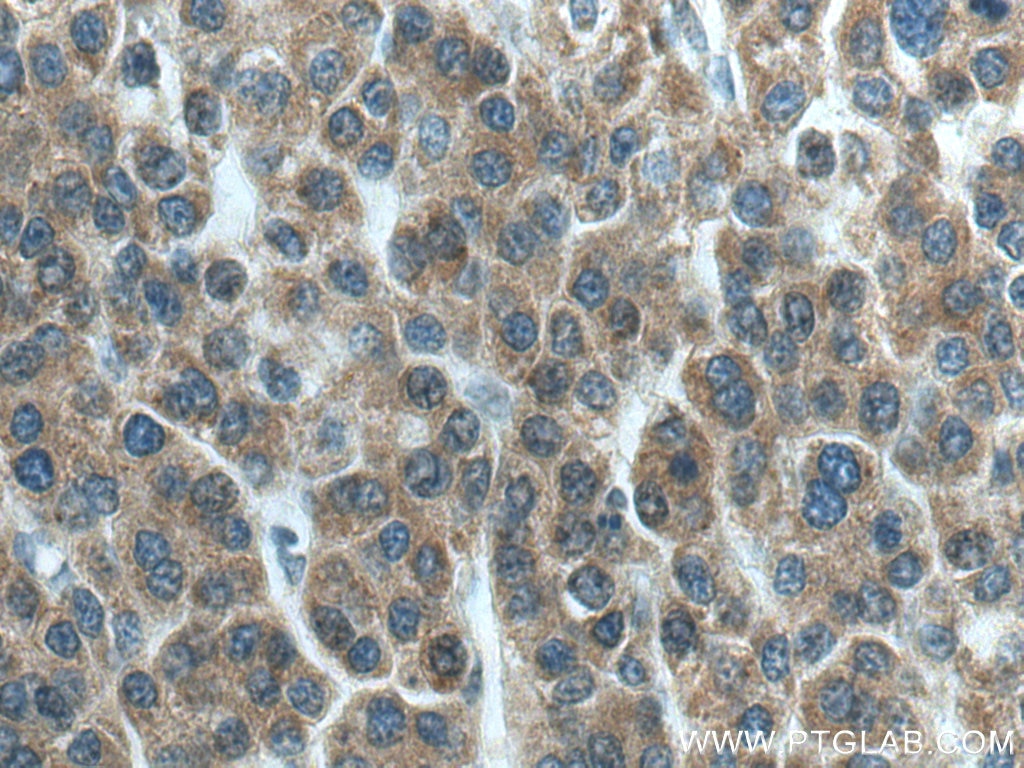 Immunohistochemistry (IHC) staining of human liver cancer tissue using GAB2 Polyclonal antibody (29272-1-AP)