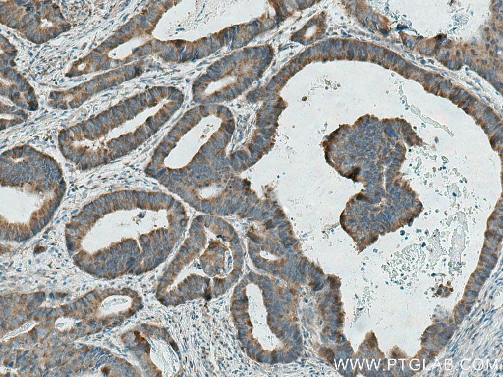 Immunohistochemistry (IHC) staining of human colon cancer tissue using GAB2 Polyclonal antibody (29272-1-AP)