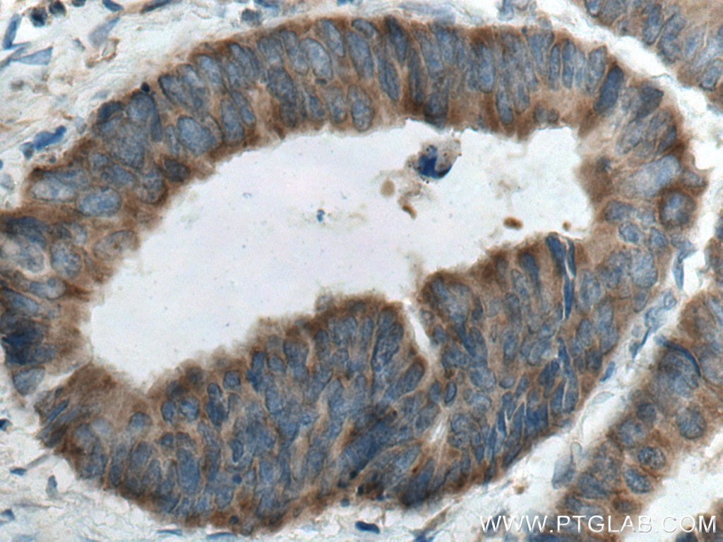Immunohistochemistry (IHC) staining of human colon cancer tissue using GAB2 Polyclonal antibody (29272-1-AP)