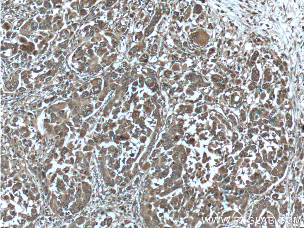 Immunohistochemistry (IHC) staining of human liver cancer tissue using GAB3-Specific Polyclonal antibody (20089-1-AP)
