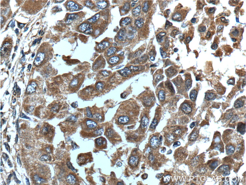 Immunohistochemistry (IHC) staining of human liver cancer tissue using GAB3-Specific Polyclonal antibody (20089-1-AP)