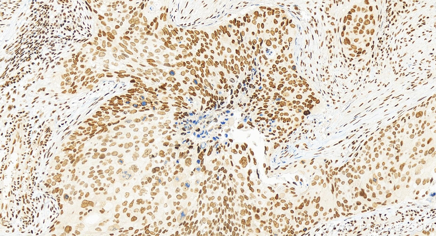 Immunohistochemistry (IHC) staining of human cervical cancer tissue using GABPA Recombinant antibody (84951-4-RR)