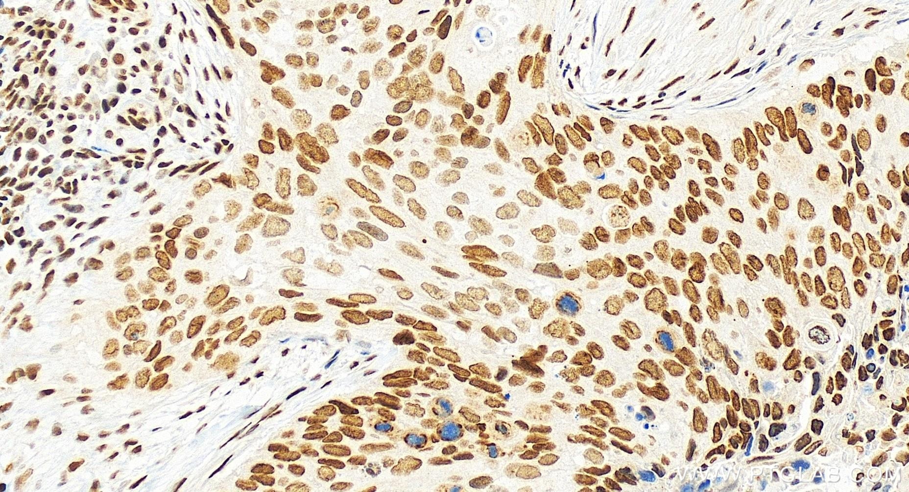 Immunohistochemistry (IHC) staining of human cervical cancer tissue using GABPA Recombinant antibody (84951-4-RR)