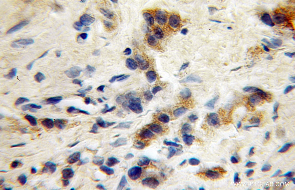 Immunohistochemistry (IHC) staining of human gliomas tissue using GABRG1 Polyclonal antibody (12871-1-AP)