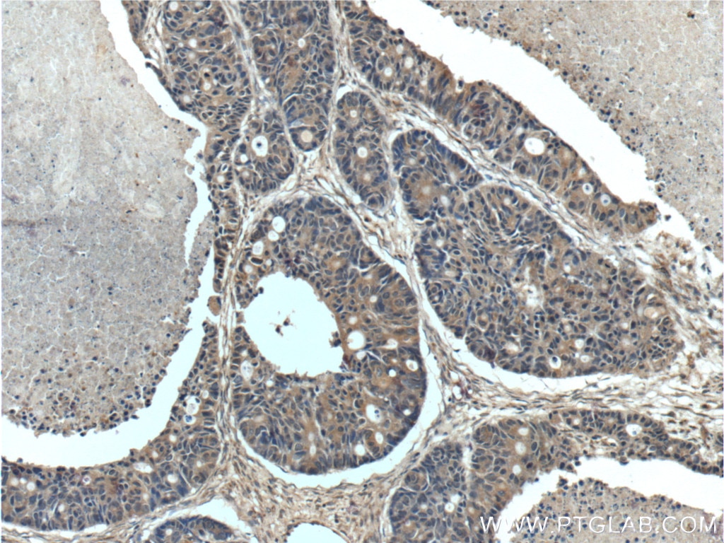 Immunohistochemistry (IHC) staining of human pancreas cancer tissue using GAC-specific Polyclonal antibody (19958-1-AP)