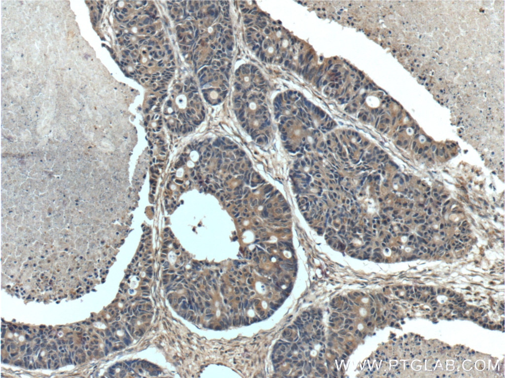 IHC staining of human pancreas cancer using 19958-1-AP