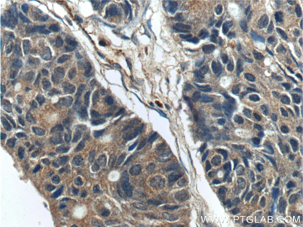 Immunohistochemistry (IHC) staining of human pancreas cancer tissue using GAC-specific Polyclonal antibody (19958-1-AP)