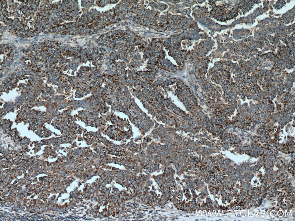 Immunohistochemistry (IHC) staining of human ovary tumor tissue using GADD45GIP1 Polyclonal antibody (16260-1-AP)