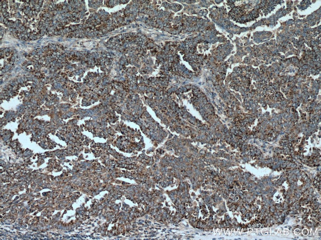 IHC staining of human ovary tumor using 16260-1-AP