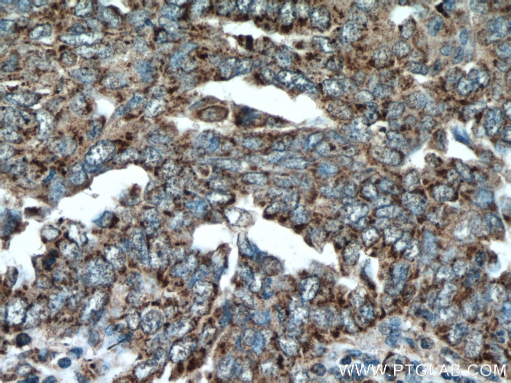 Immunohistochemistry (IHC) staining of human ovary tumor tissue using GADD45GIP1 Polyclonal antibody (16260-1-AP)