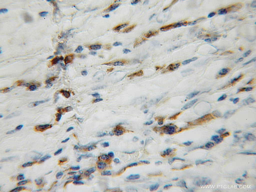 Immunohistochemistry (IHC) staining of human lung cancer tissue using GAGE1 Polyclonal antibody (12795-1-AP)