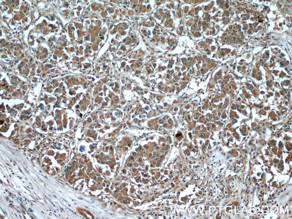 IHC staining of human liver cancer using 12532-1-AP