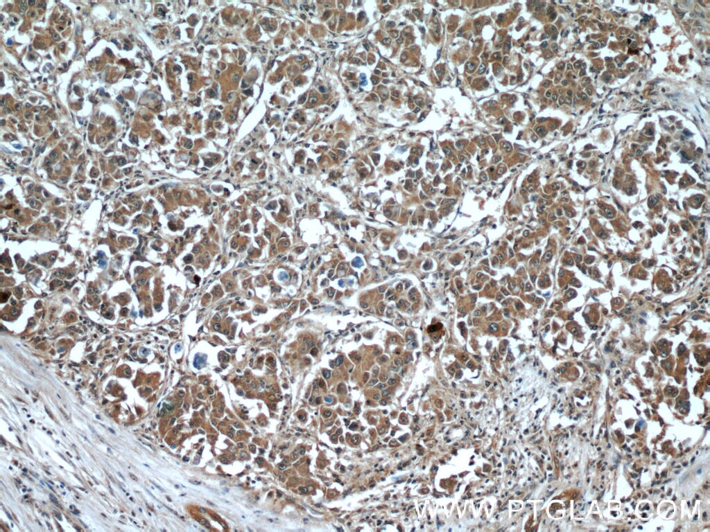 IHC staining of human liver cancer using 12532-1-AP