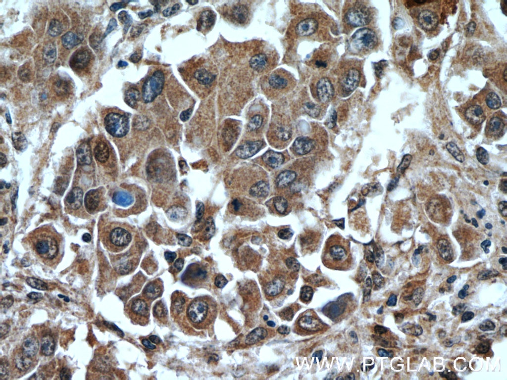 Immunohistochemistry (IHC) staining of human liver cancer tissue using GAGE2D Polyclonal antibody (12532-1-AP)