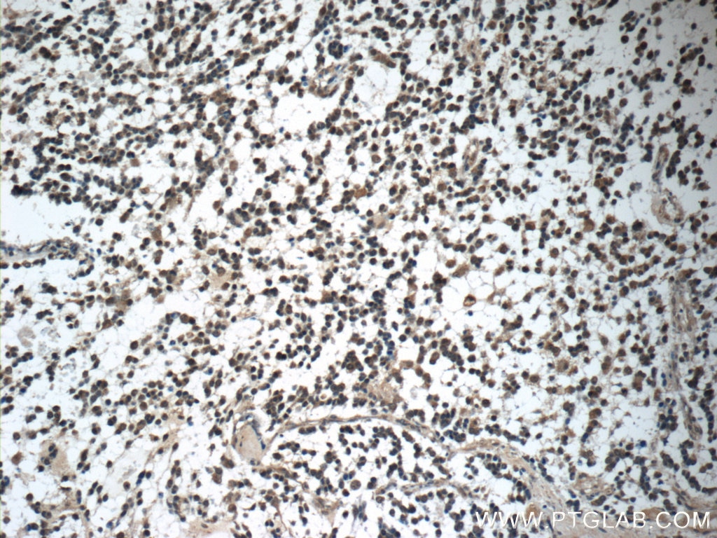 Immunohistochemistry (IHC) staining of human gliomas tissue using GAGE7 Polyclonal antibody (12945-1-AP)