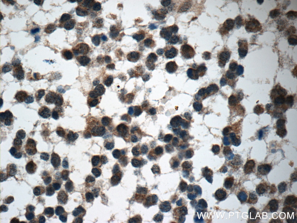 Immunohistochemistry (IHC) staining of human gliomas tissue using GAGE7 Polyclonal antibody (12945-1-AP)