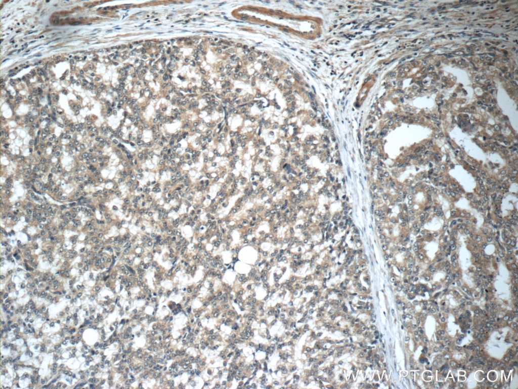 Immunohistochemistry (IHC) staining of human prostate cancer tissue using GAGE7 Polyclonal antibody (12945-1-AP)