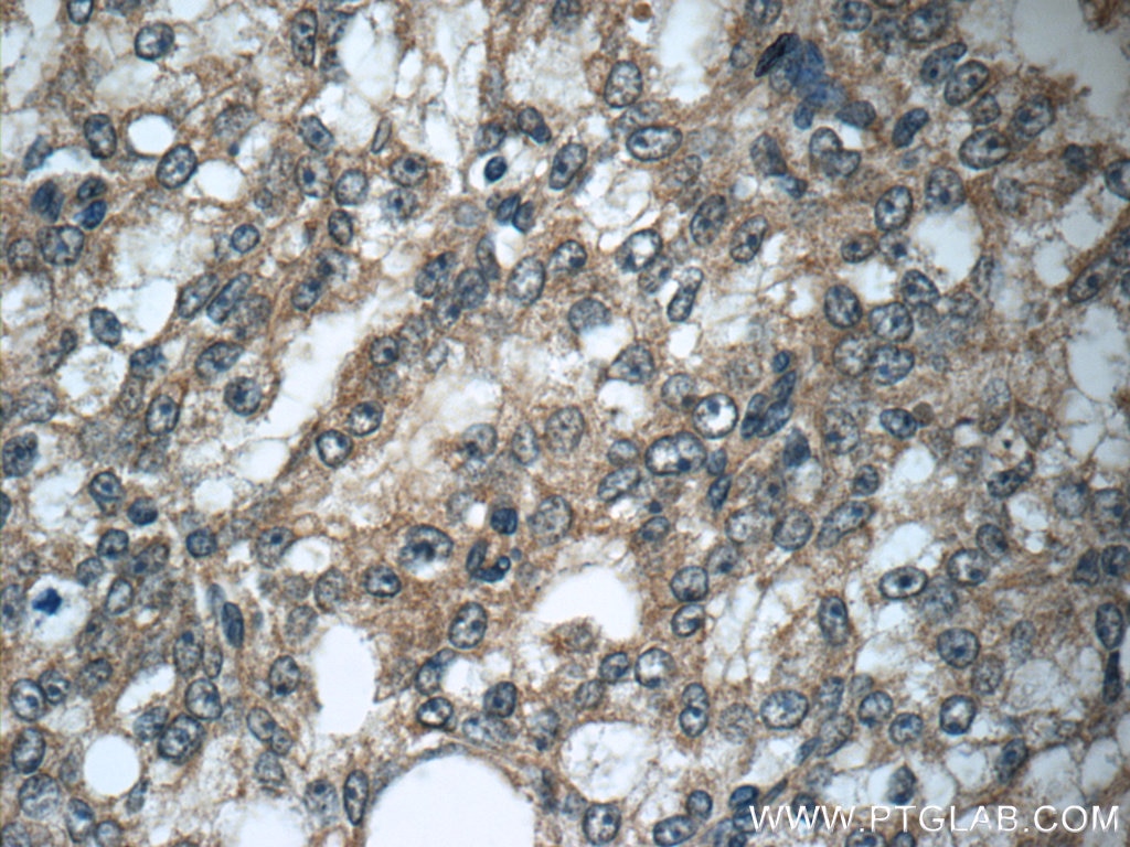 Immunohistochemistry (IHC) staining of human prostate cancer tissue using GAGE7 Polyclonal antibody (12945-1-AP)