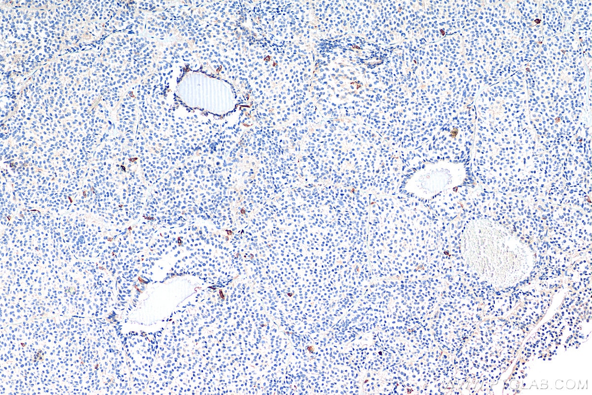 Immunohistochemistry (IHC) staining of human pituitary adenoma tissue using Galanin Polyclonal antibody (13307-1-AP)