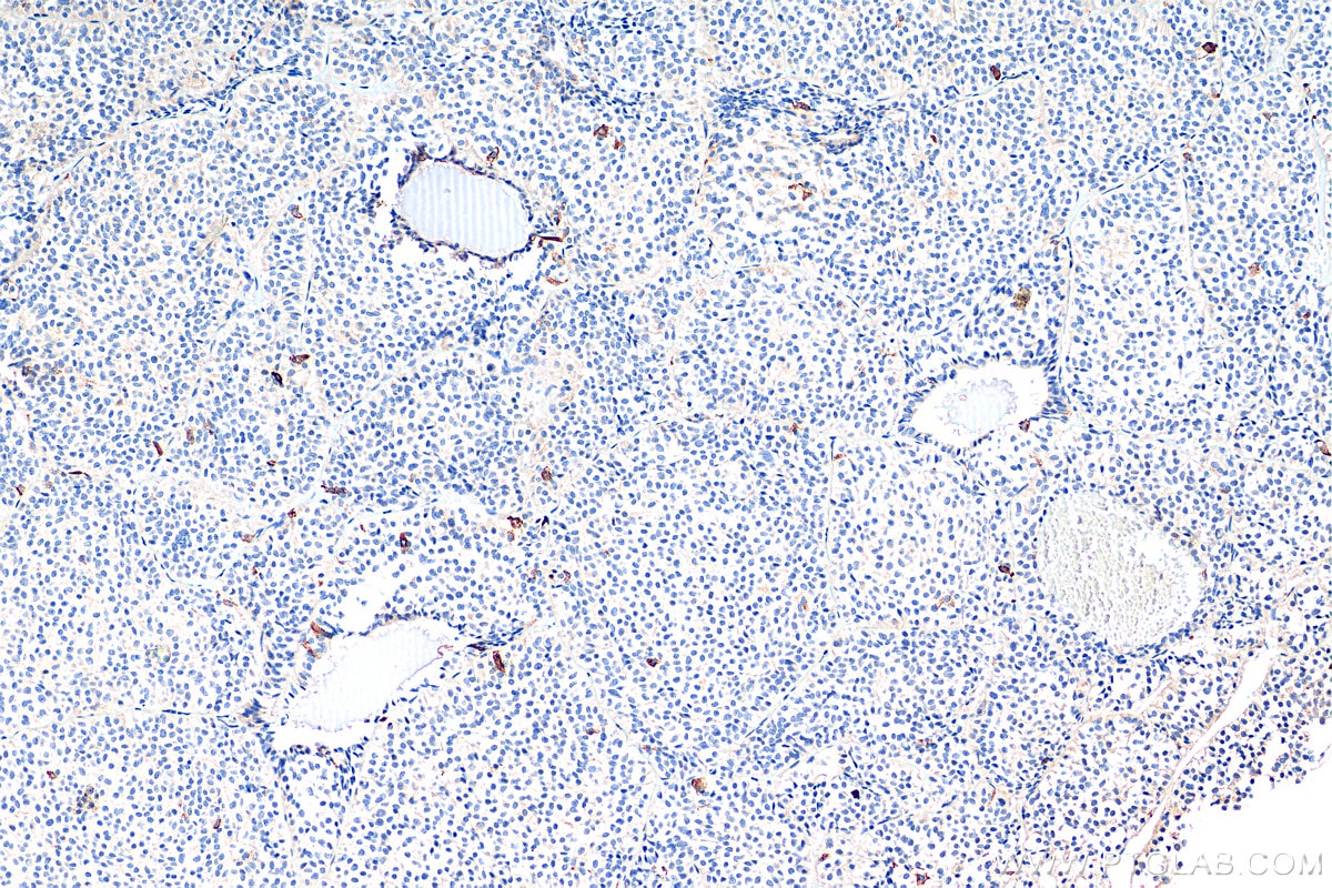 IHC staining of human pituitary adenoma using 13307-1-AP