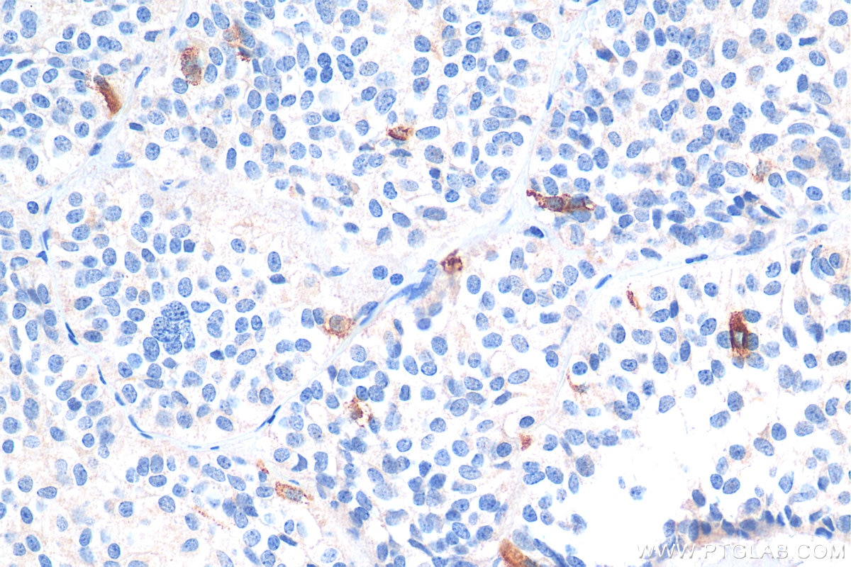 Immunohistochemistry (IHC) staining of human pituitary adenoma tissue using Galanin Polyclonal antibody (13307-1-AP)