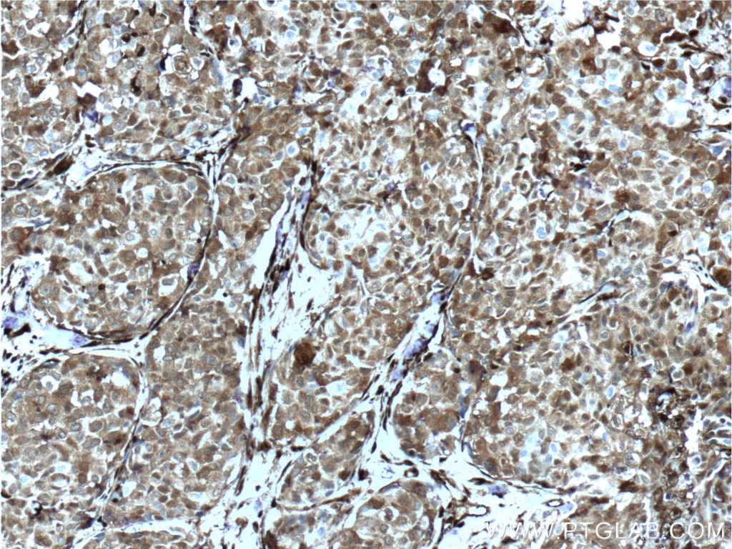 Immunohistochemistry (IHC) staining of human lung cancer tissue using Galectin-1 Polyclonal antibody (11858-1-AP)