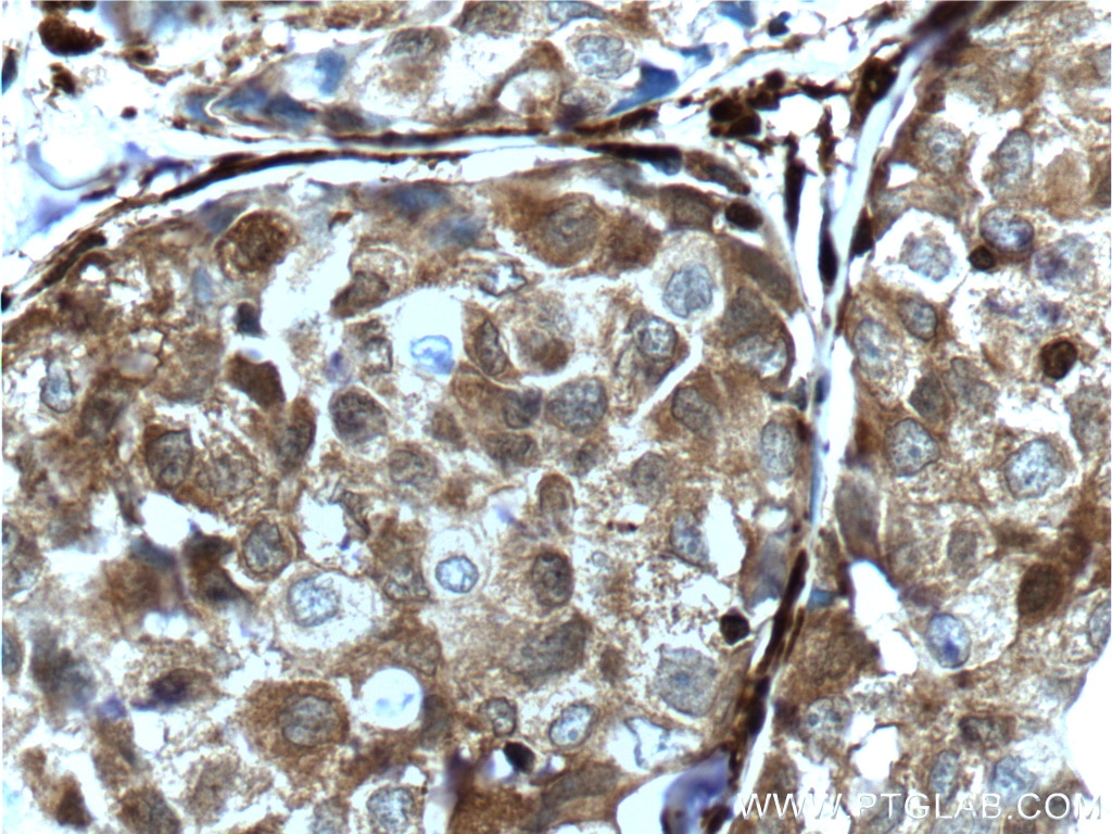 Immunohistochemistry (IHC) staining of human lung cancer tissue using Galectin-1 Polyclonal antibody (11858-1-AP)
