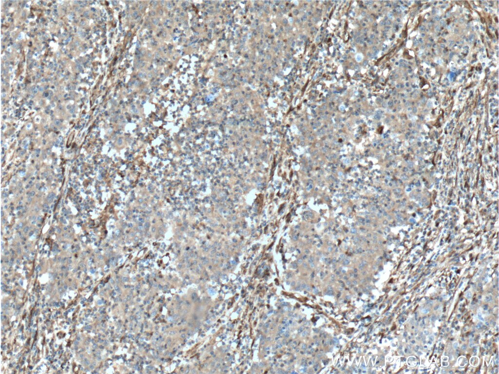 Immunohistochemistry (IHC) staining of human colon cancer tissue using Galectin-1 Polyclonal antibody (11858-1-AP)