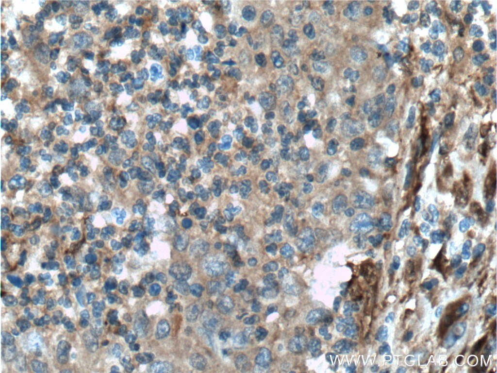 Immunohistochemistry (IHC) staining of human colon cancer tissue using Galectin-1 Polyclonal antibody (11858-1-AP)