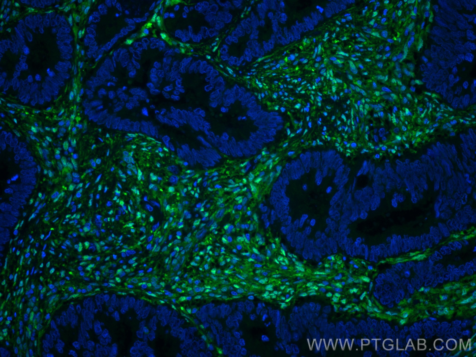 Immunofluorescence (IF) / fluorescent staining of human colon cancer tissue using Galectin-1 Monoclonal antibody (60223-1-Ig)