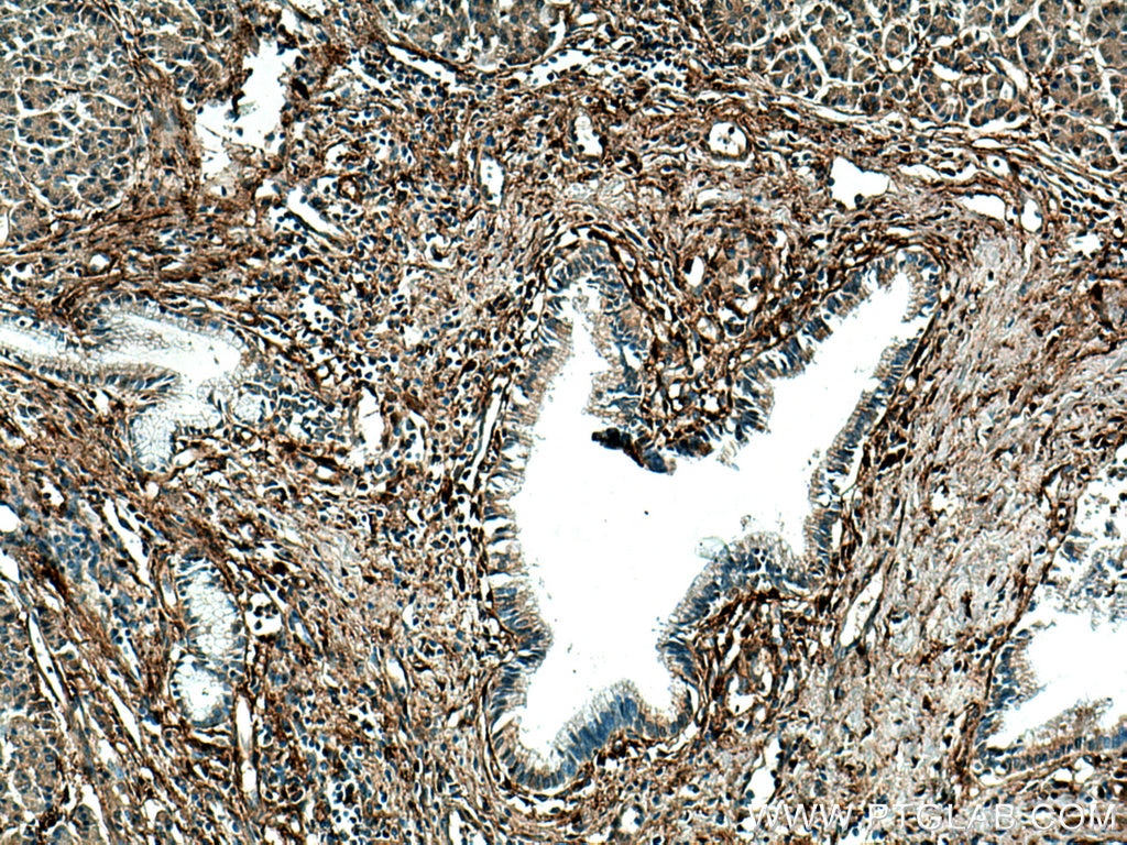 Immunohistochemistry (IHC) staining of human pancreas cancer tissue using Galectin-1 Monoclonal antibody (60223-1-Ig)