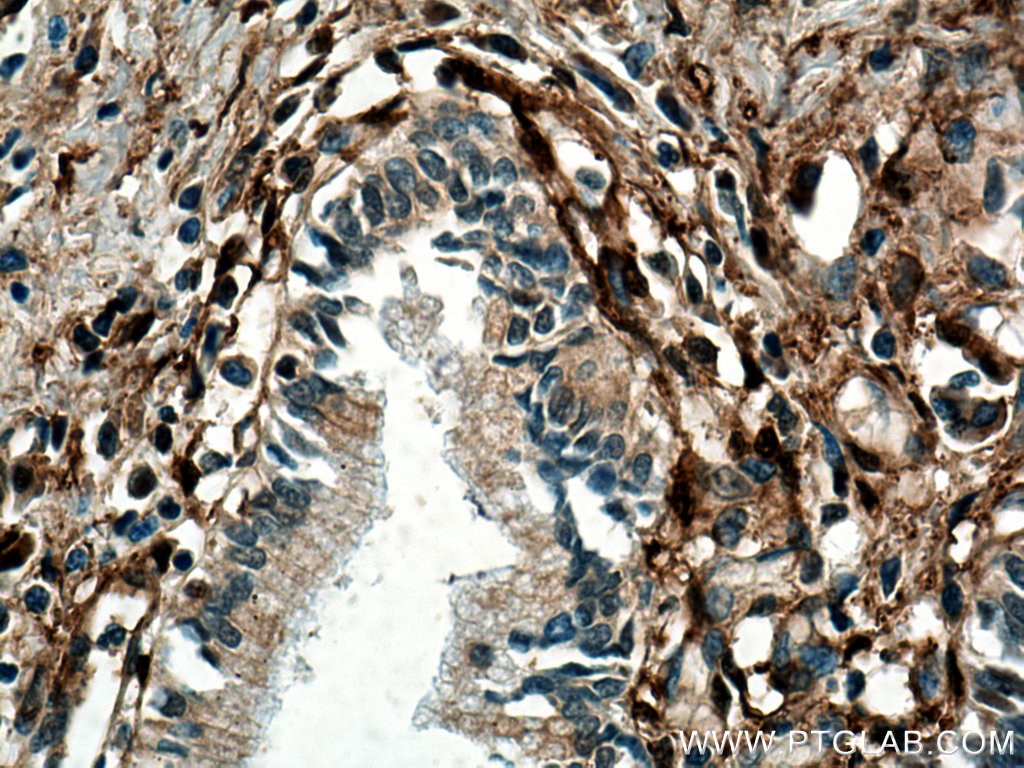 Immunohistochemistry (IHC) staining of human pancreas cancer tissue using Galectin-1 Monoclonal antibody (60223-1-Ig)