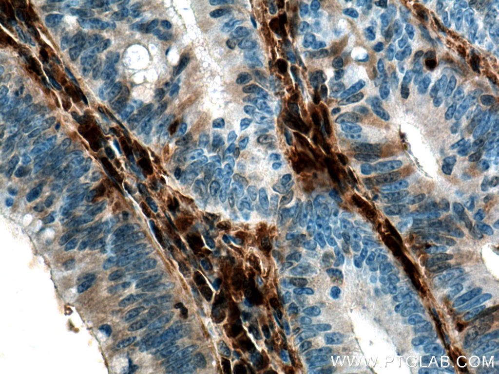 Immunohistochemistry (IHC) staining of human colon cancer tissue using Galectin-1 Monoclonal antibody (60223-1-Ig)