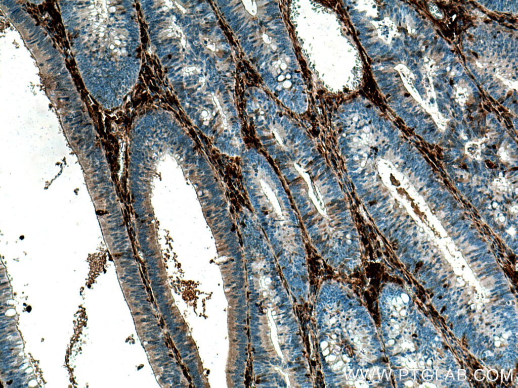 Immunohistochemistry (IHC) staining of human colon cancer tissue using Galectin-1 Monoclonal antibody (60223-1-Ig)