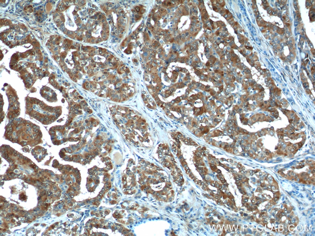 Immunohistochemistry (IHC) staining of human thyroid cancer tissue using Galectin-3 Polyclonal antibody (14979-1-AP)
