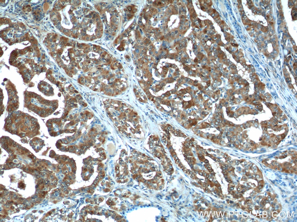 IHC staining of human thyroid cancer using 14979-1-AP