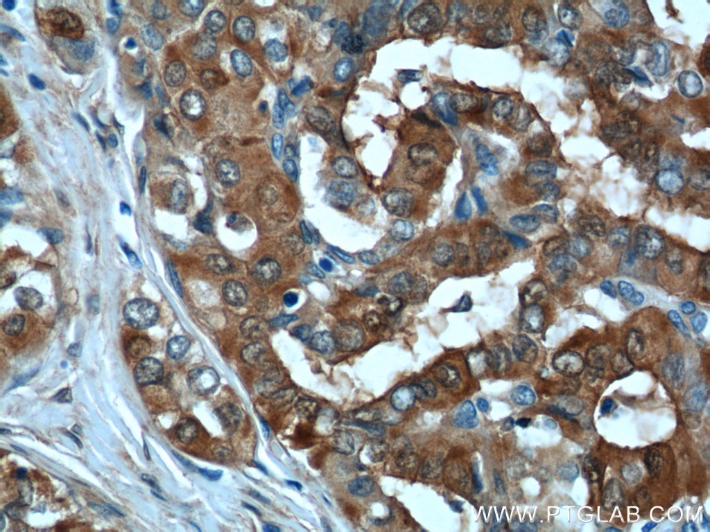 Immunohistochemistry (IHC) staining of human thyroid cancer tissue using Galectin-3 Polyclonal antibody (14979-1-AP)