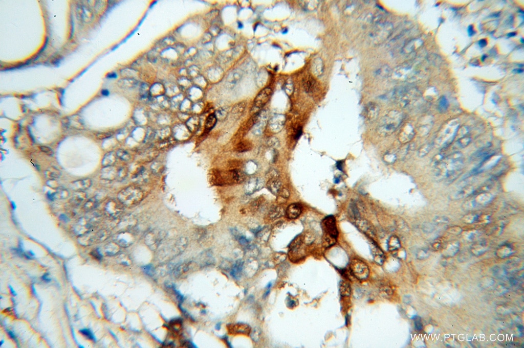 Immunohistochemistry (IHC) staining of human colon cancer tissue using Galectin-3 Polyclonal antibody (14979-1-AP)