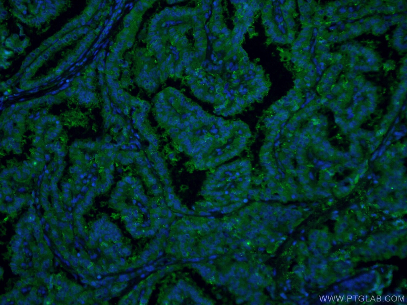 Immunofluorescence (IF) / fluorescent staining of human thyroid cancer tissue using Galectin-3 Monoclonal antibody (60207-1-Ig)