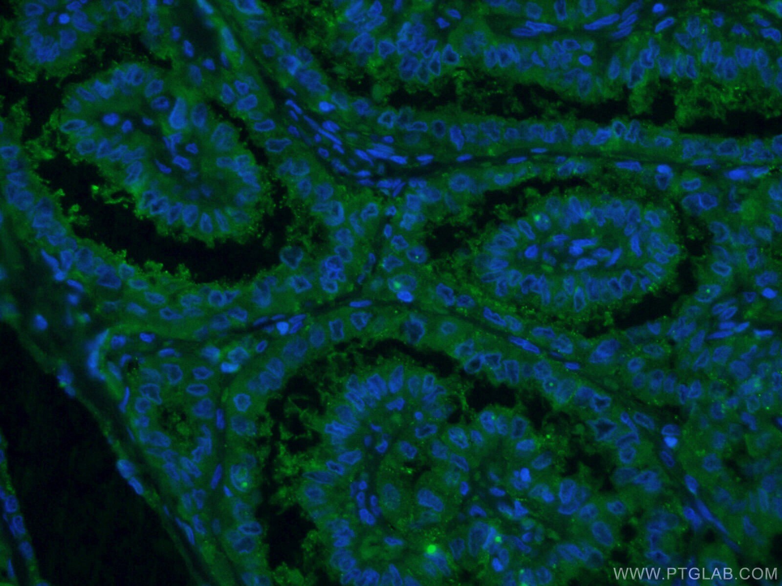 Galectin-3